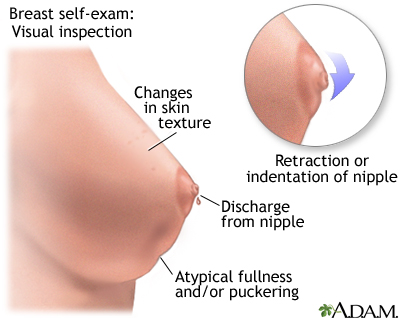 Breast self-exam