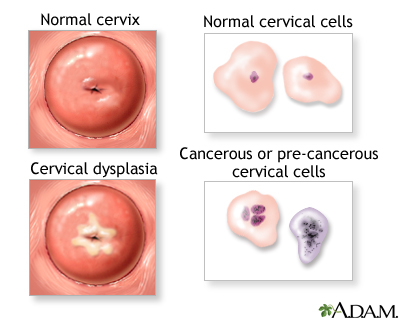 Cervical neoplasia