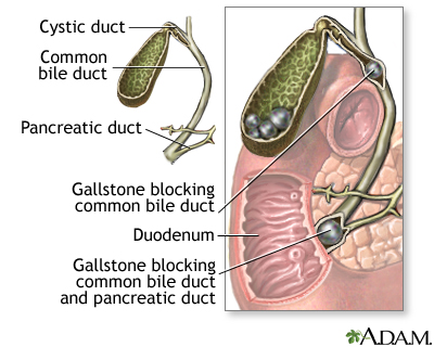 Choledocholithiasis