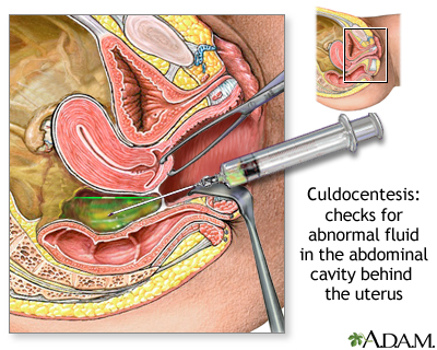 Culdocentesis