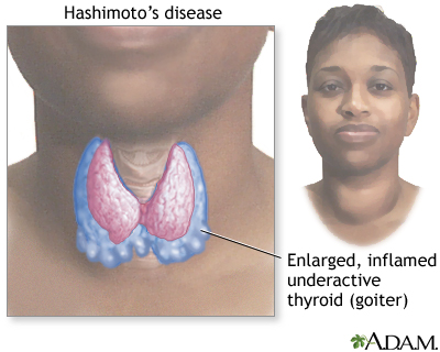 Hashimoto's disease (chronic thyroiditis)