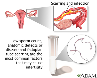 Primary infertility