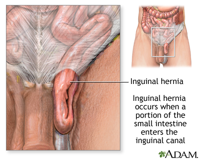 Inguinal hernia