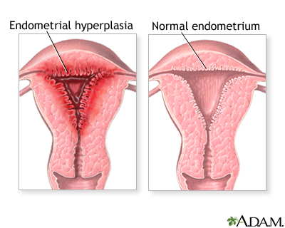 Abnormal menstrual periods