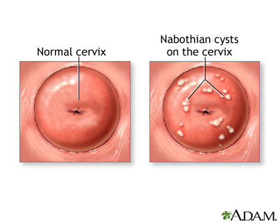 Nabothian cyst