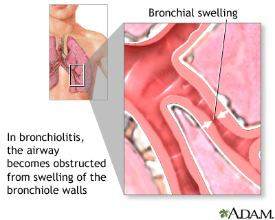 Bronchiolitis