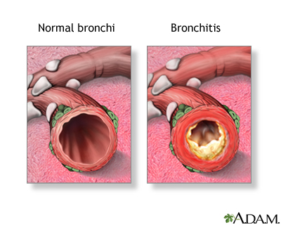 Bronchitis