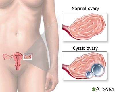 Ovarian cysts