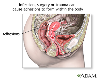 Pelvic adhesions