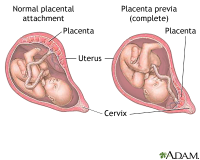 Placenta previa