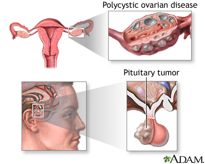 Secondary amenorrhea