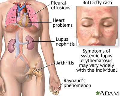 Systemic lupus erythematosus