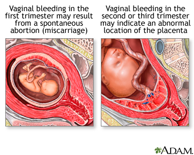 Vaginal bleeding during pregnancy