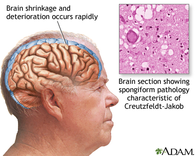 Creutzfeldt-Jakob disease