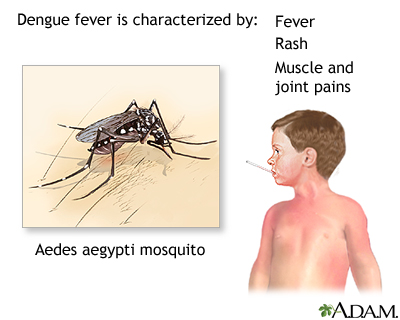 Dengue fever