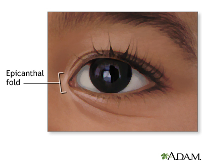 Epicanthal fold
