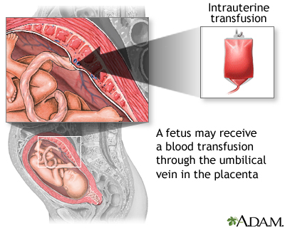 Intrauterine transfusion