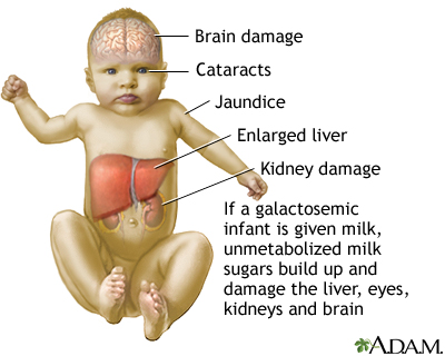 Galactosemia