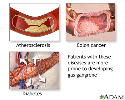 Gas gangrene