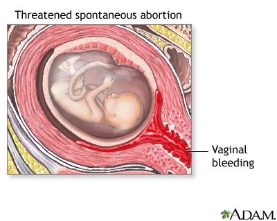 Miscarriage