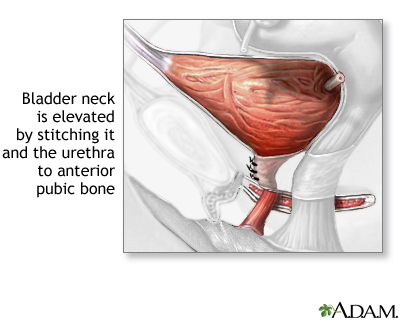 Stress incontinence