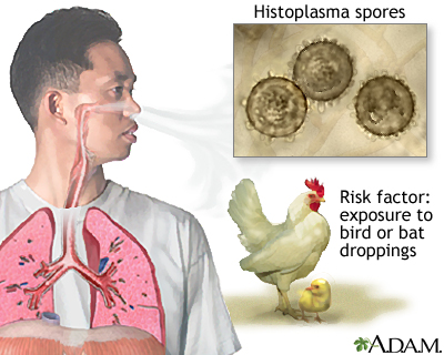 Acute histoplasmosis