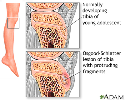 Leg pain (Osgood-Schlatter)