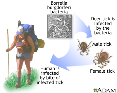 Lyme disease