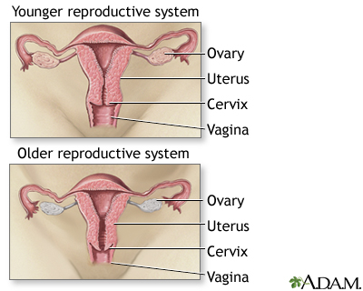 Menopause