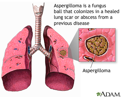 Aspergilloma