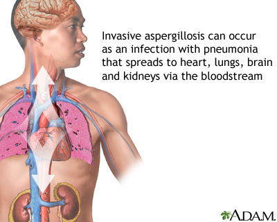 Pulmonary aspergillosis