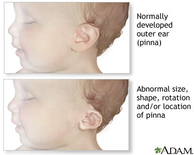 Ear abnormalities