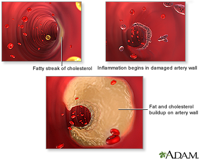 Arterial plaque build-up