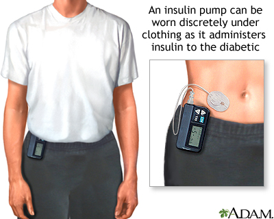 Insulin pump