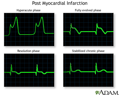 Post myocardial infarction ECG wave tracings