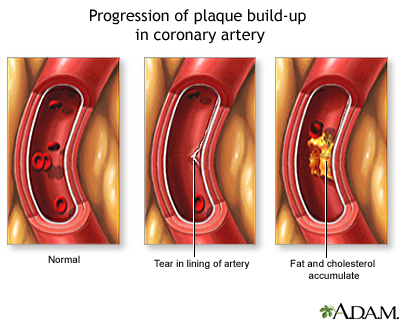 Progressive build-up of plaque in coronary artery