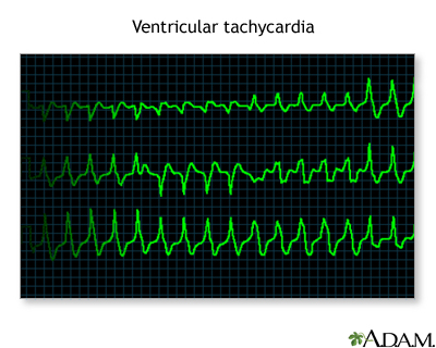 Ventricular tachycardia