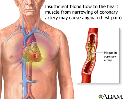 Stable angina