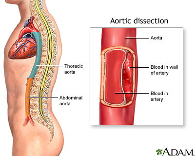 Aortic dissection