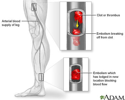 Arterial embolism