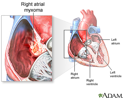 Right atrial myxoma