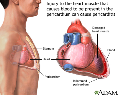 Post-MI pericarditis