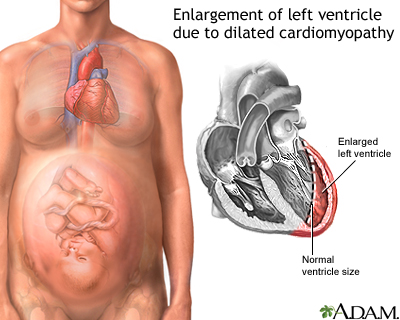 Peripartum cardiomyopathy