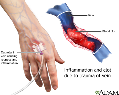 Superficial thrombophlebitis