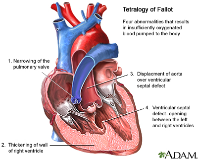 Tetralogy of Fallot