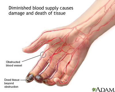 Thromboangiites obliterans