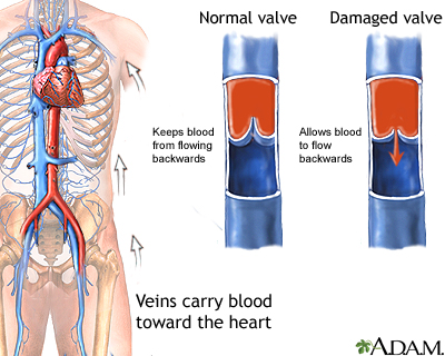 Venous insufficiency