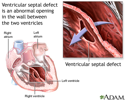 Ventricular septal defect