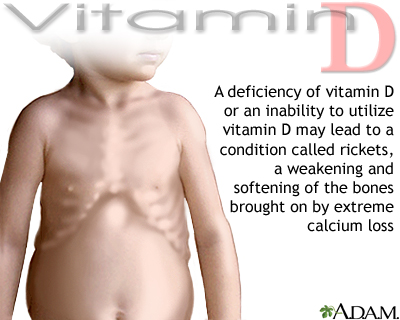 Vitamin D deficit