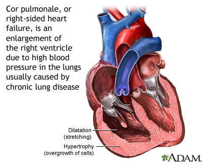 Cor pulmonale